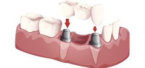 Dental-Implant_diagram2