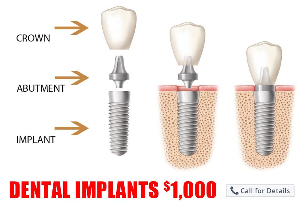 Dental Implants Eugene Corvallis Salem Roseburg Florence