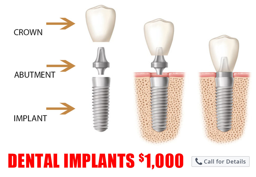 Dental Implants Eugene Corvallis Salem Roseburg Florence